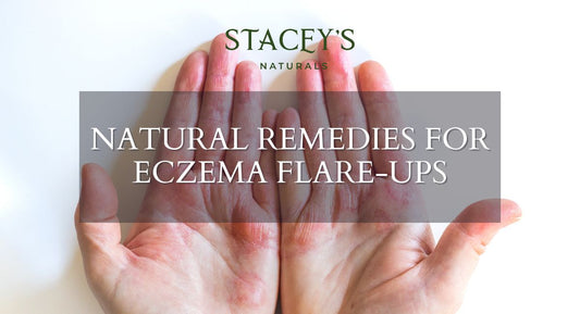 Natural Remedies for Eczema Flare-Ups