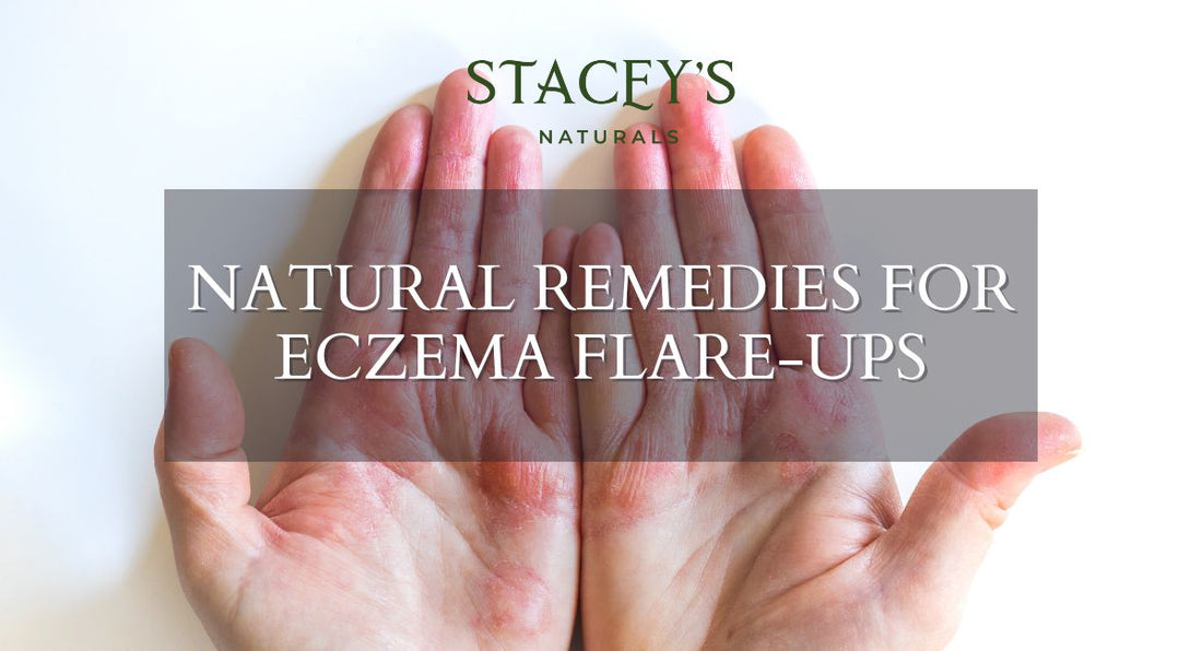 Natural Remedies for Eczema Flare-Ups